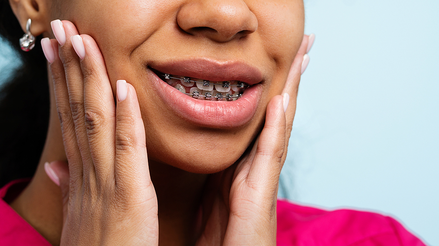 Braces for Your Smile: How They Improve More Than Just Your Looks