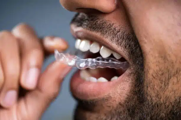 Invisalign Journey Explained: From Consultation to Completion