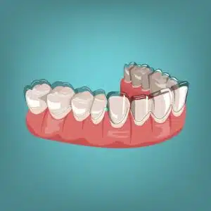 Invisalign Journey Explained: From Consultation to Completion